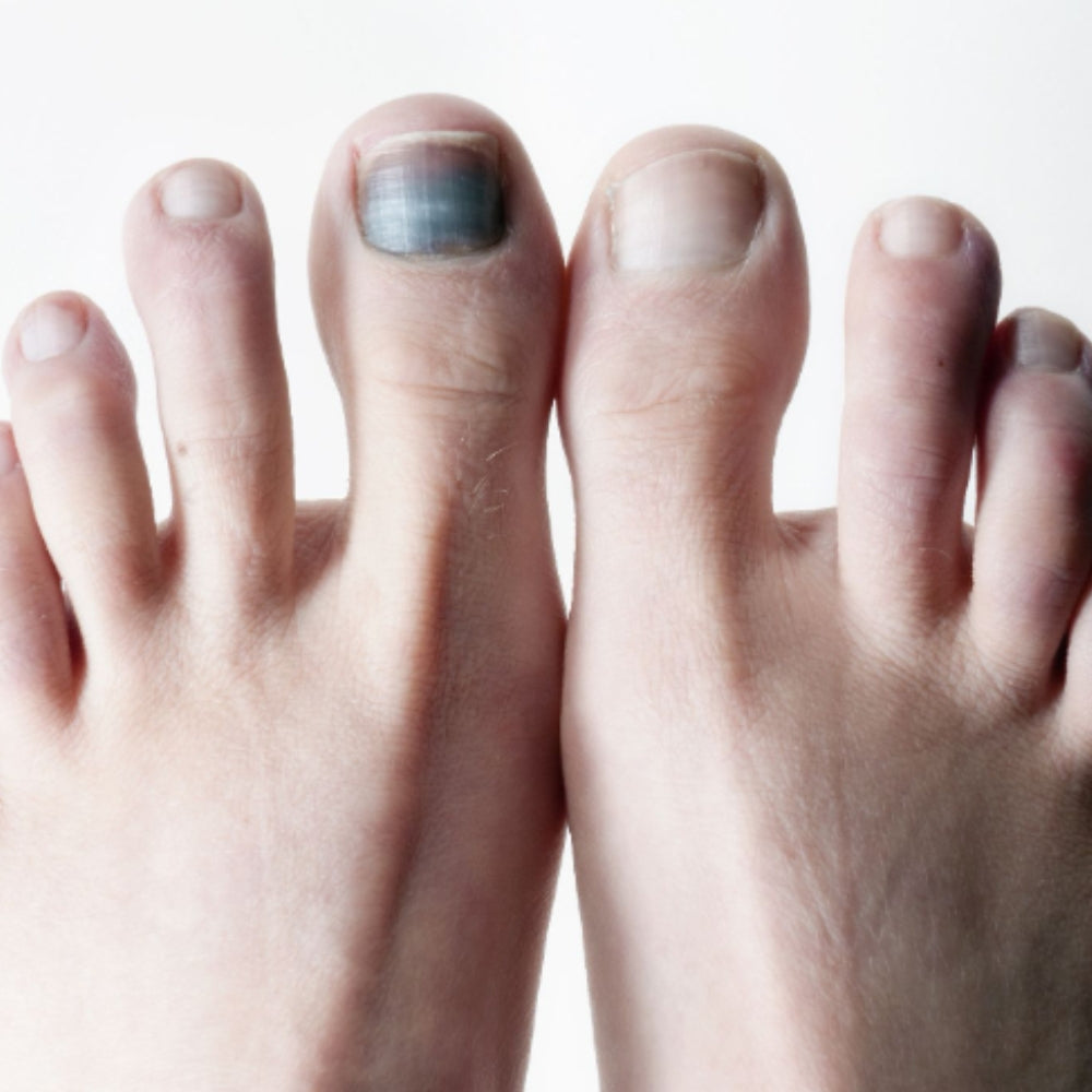 Mang giày bị bầm móng chân